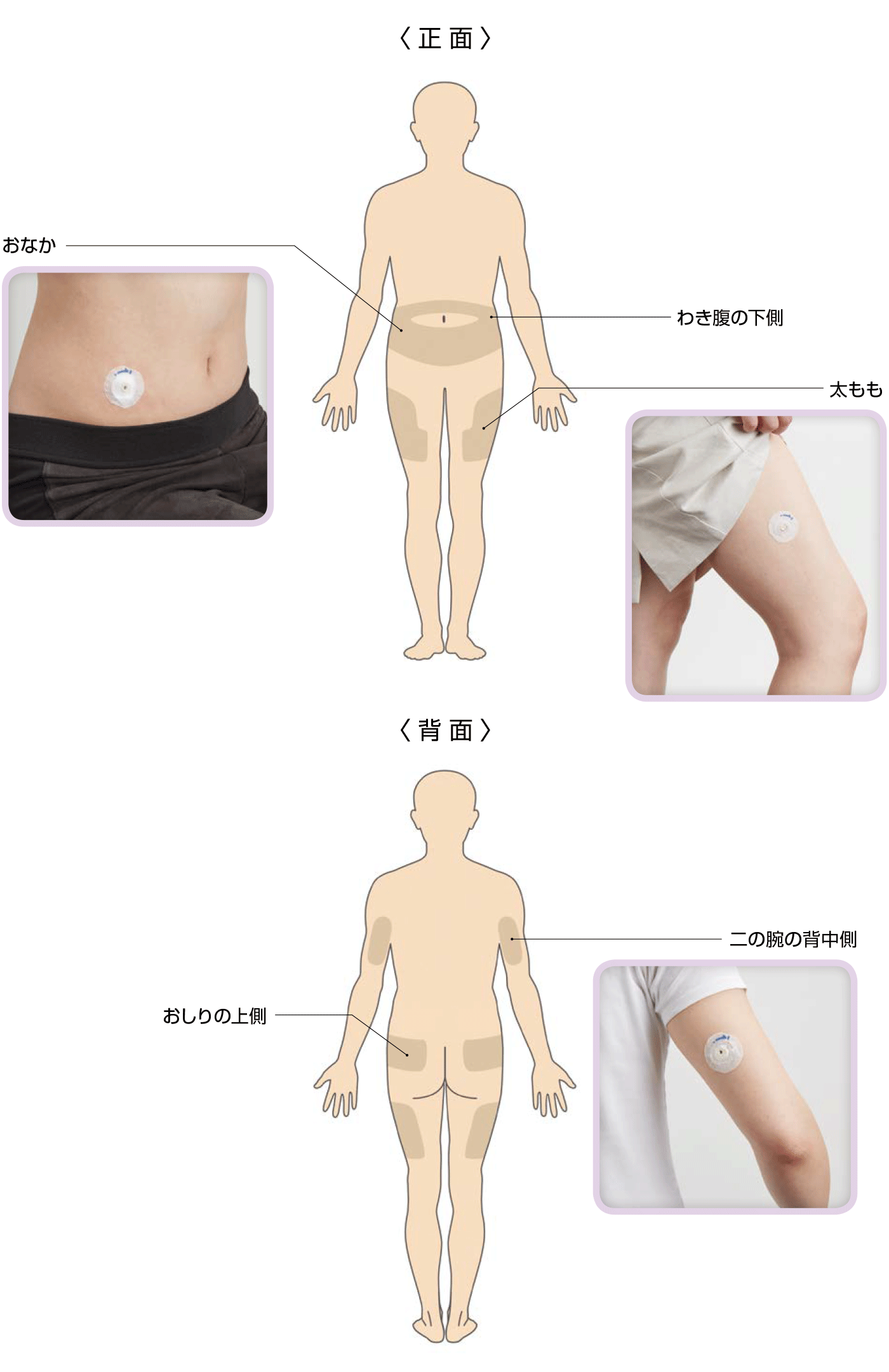 注射部位の選択　次の部位にも投与が可能です。おしりの上側、わき腹の下側、二の腕の背中側、太もも