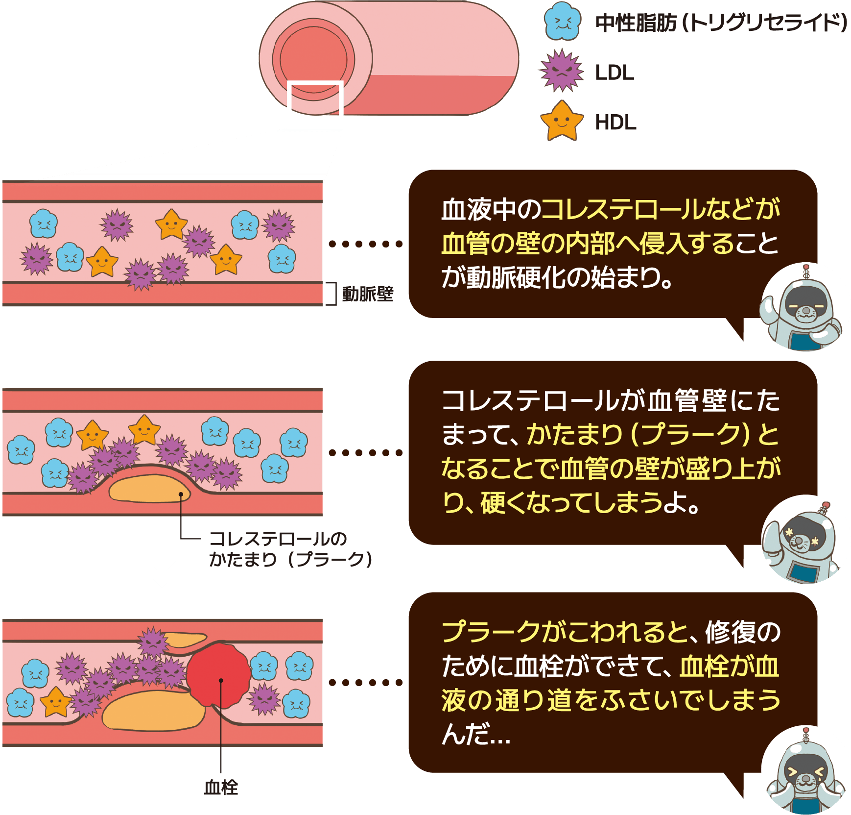 動脈硬化の進み方