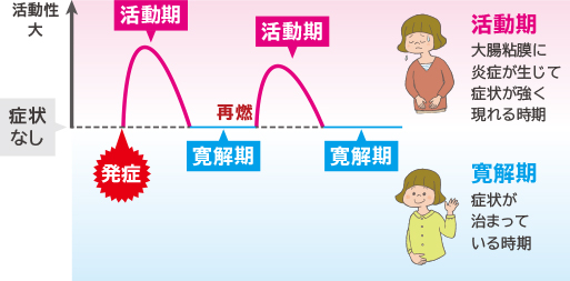 潰瘍性大腸炎の経過