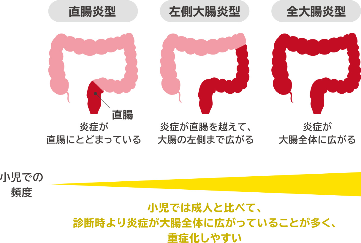 炎症の広がり方によって、大きく3つのタイプに分かれます