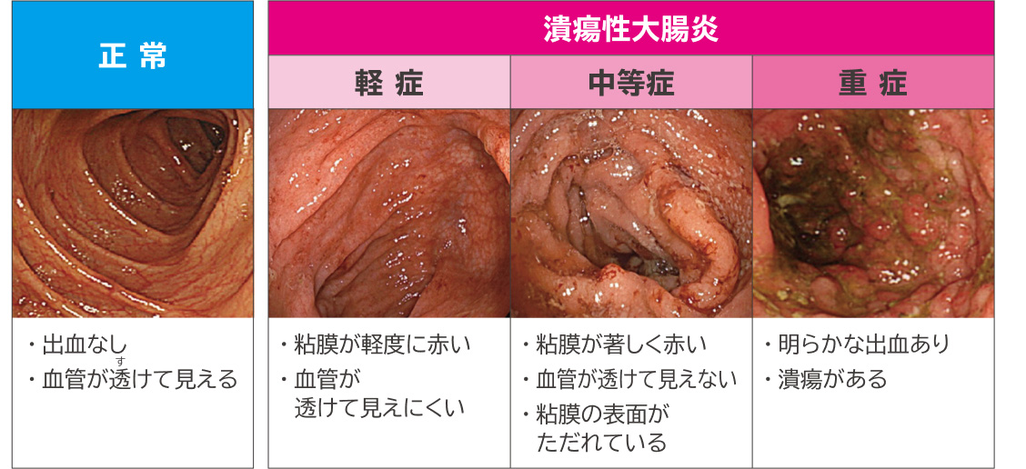 大腸内視鏡検査