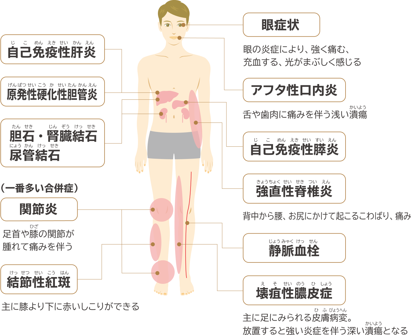 腸管合併症と腸管外合併症