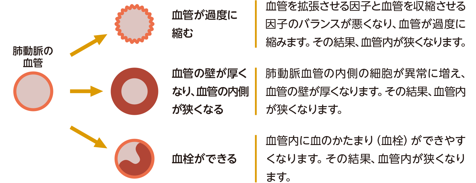 肺高血圧症の肺動脈内で起こること