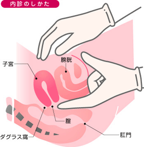 病院で行う検査で何がわかるの 子宮内膜症