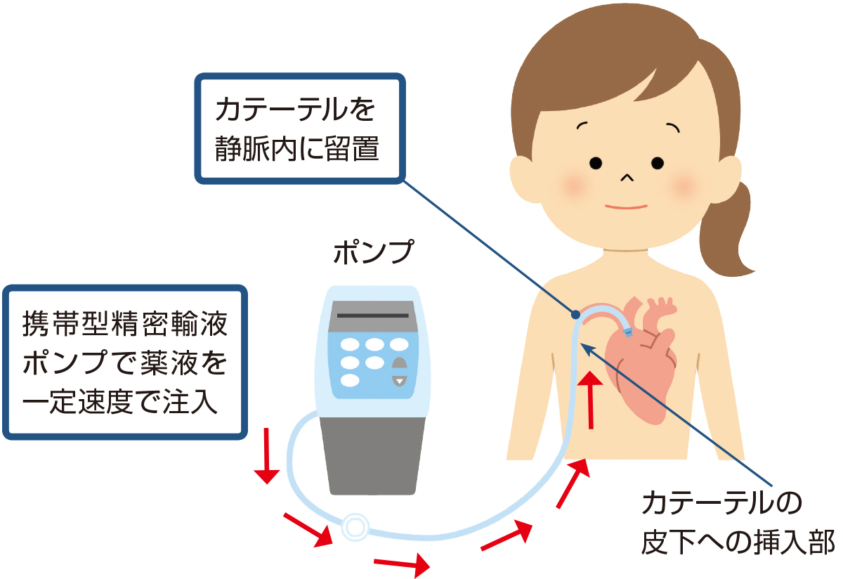 トレプロスト(R)注射液の使用方法