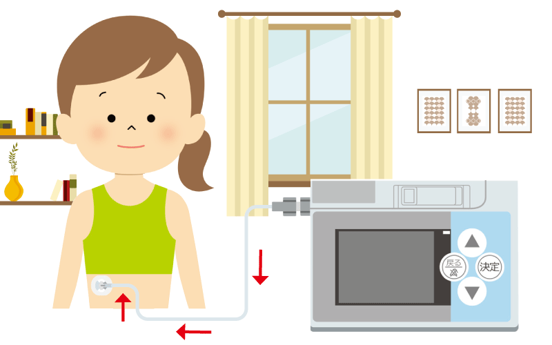 在宅での治療②持続皮下投与療法