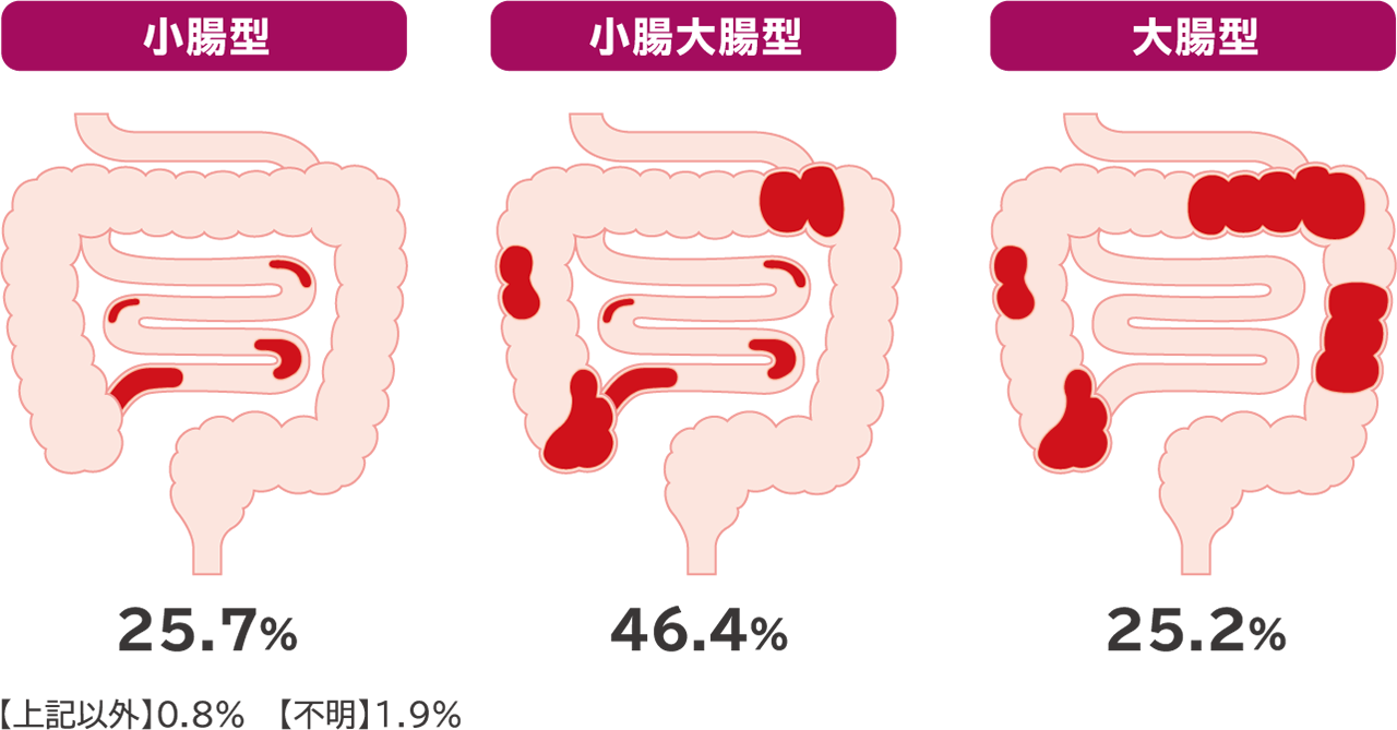 クローン病の病変の拡がり