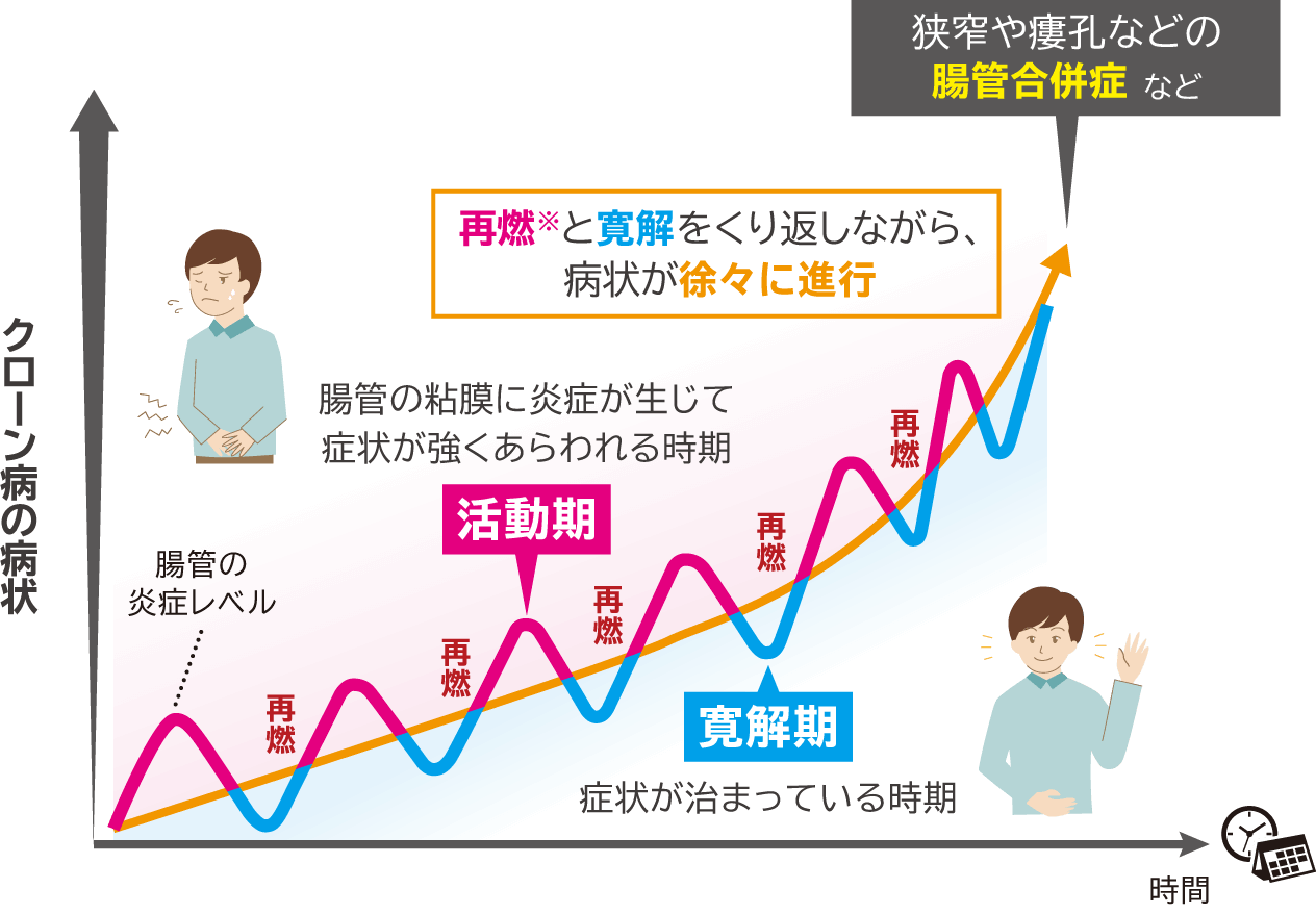 クローン病の経過と進行