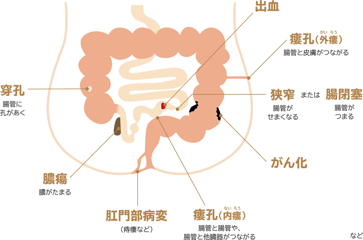 腸管合併症