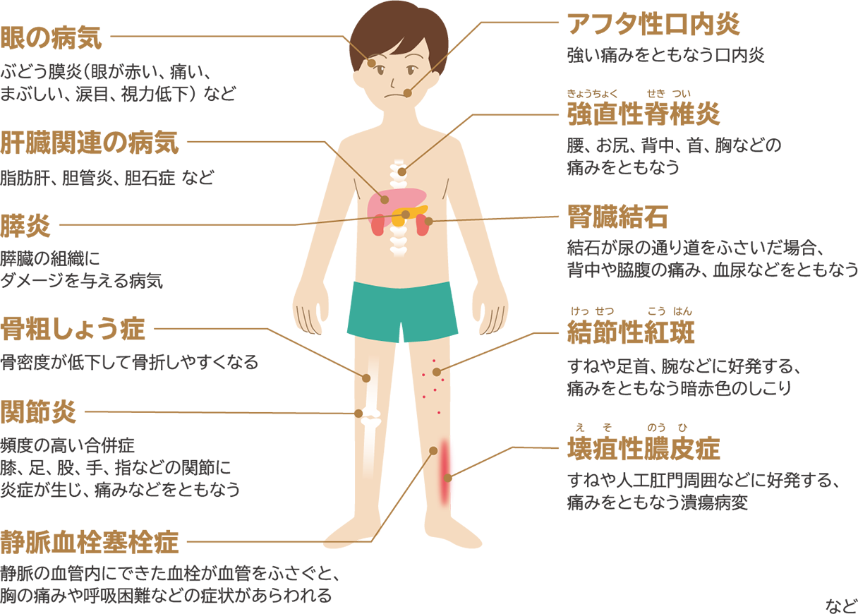 クローン病の女性が妊娠するのは安全ですか?