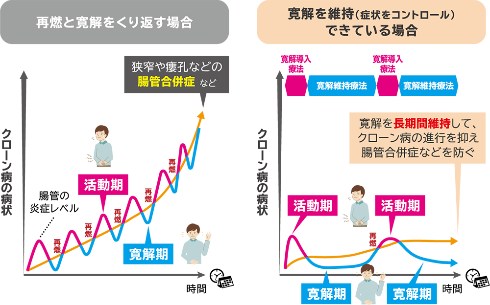 クローン病の治療の種類と治療目標